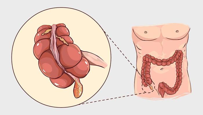 Аппендицит
